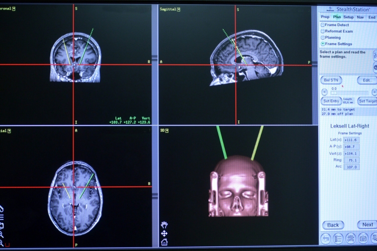 Gyógyíthatóvá válhat a Parkinson-kór 