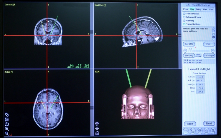 Gyógyíthatóvá válhat a Parkinson-kór 