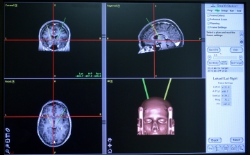 Gyógyíthatóvá válhat a Parkinson-kór 